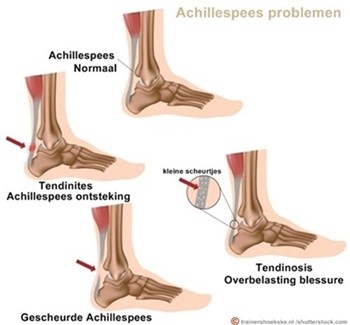 Achillespeesontsteking Achillespees Tendinopathie Achilles Tendinitis Achilles Tendinose Achilles Tendinopathie Schrijver Orthopedie B V