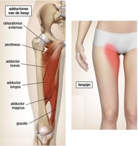 overschreden acre Zeeziekte Verrekking of Spierscheuring heupadductoren (Liesblessure, Liesverrekking,  Adductoren verrekking, Adductoren letsel, Spierscheuring van de adductoren)  ⋆ Schrijver Orthopedie B.V.